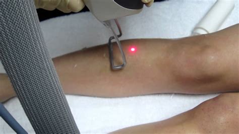 laser hair removal in los angeles